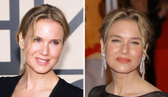 Renee Zellweger przed i po tworzywach sztucznych: porównanie