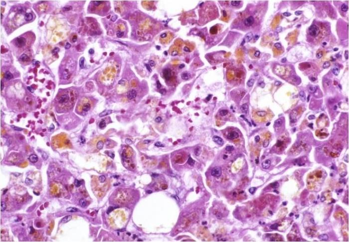 Choroba Wilsona: przyczyny, objawy, leczenie i diagnoza