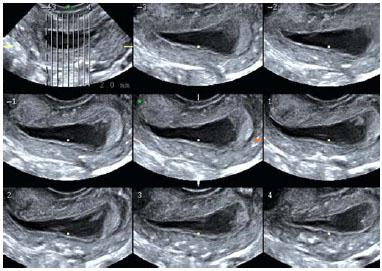 Endometrium do dnia cyklu w granicach normy i w przypadku jej odchylenia