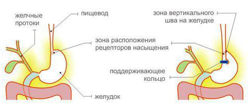 gastric bypass