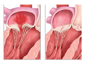 Zaburzenia funkcji zastawki mitralnej