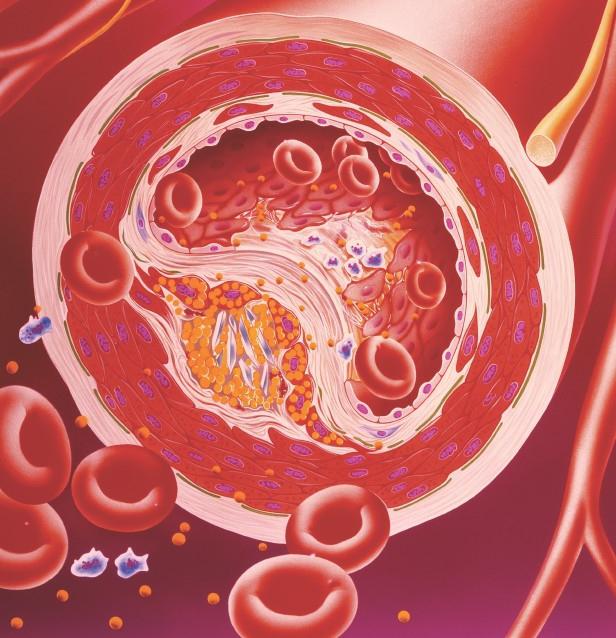 Szczegółowe informacje na temat zmniejszenia cholesterolu za pomocą środków ludowej